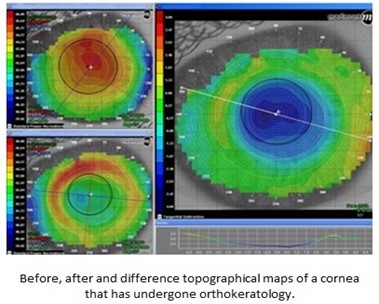 Before, after and difference topographical maps of a cornea that has undergone orthokeratology
